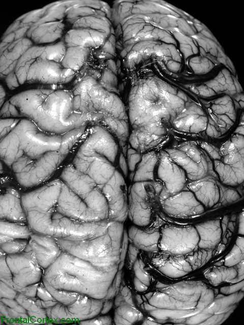 Bilateral cortical venous thrombosis, dorsal surface of brain.